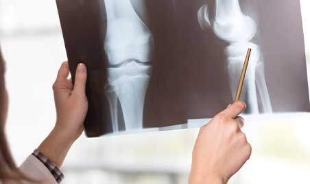 Chiropractor examines x-rays for cause of knee pain