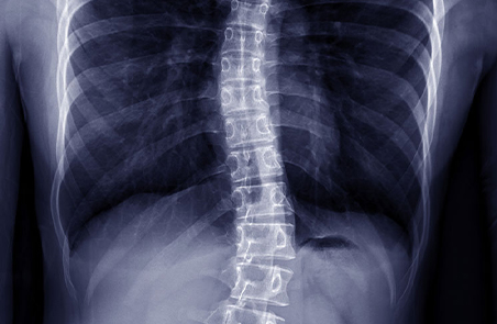 Man suffering from Scoliosis
